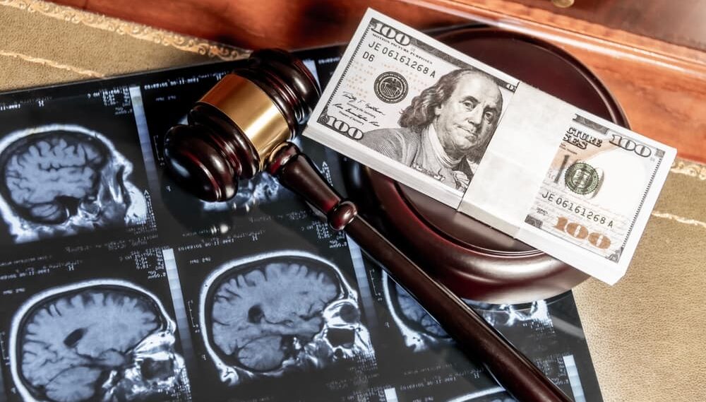 How Much Compensation Do You Get for a Brain Injury?